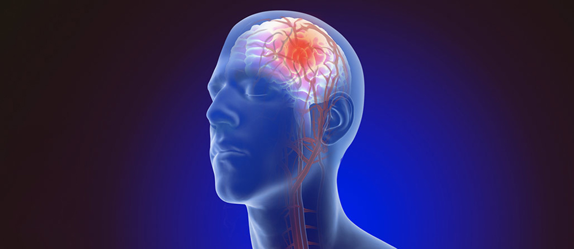 Stroke Treatment Signs Treatment Services in Plano  